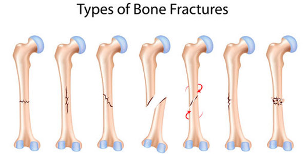 Best hip replacement surgeon in Hyderabad